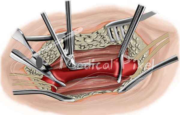 Femoral ByPass